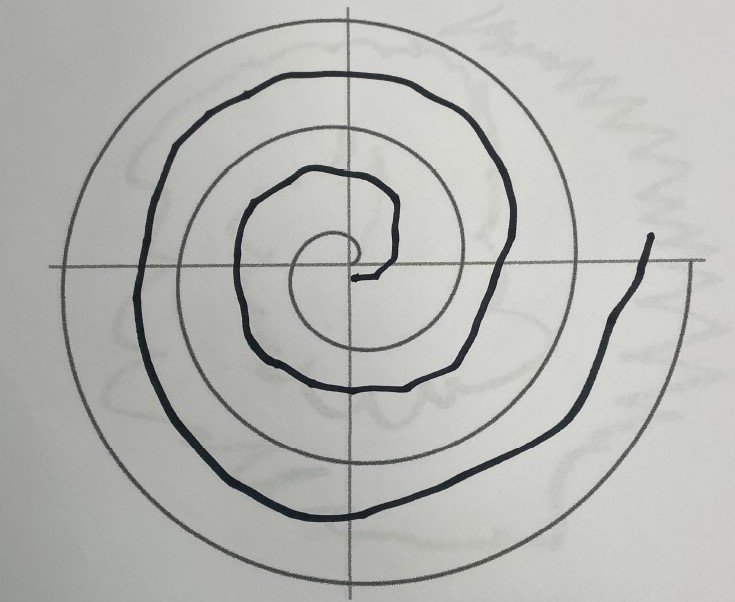 This spiral was drawn by the same patient immediately after the procedure. Today, he is 100% tremor free.